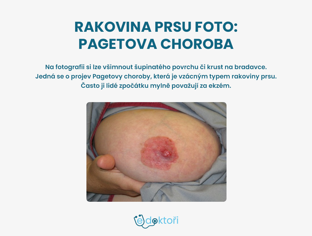 Autor: Redakce edoktori.cz rakovina prsu foto - Pagetova choroba