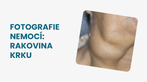 Rakovina krku foto