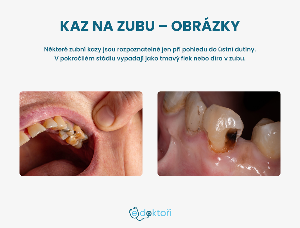 Kaz na zubu - obrázky