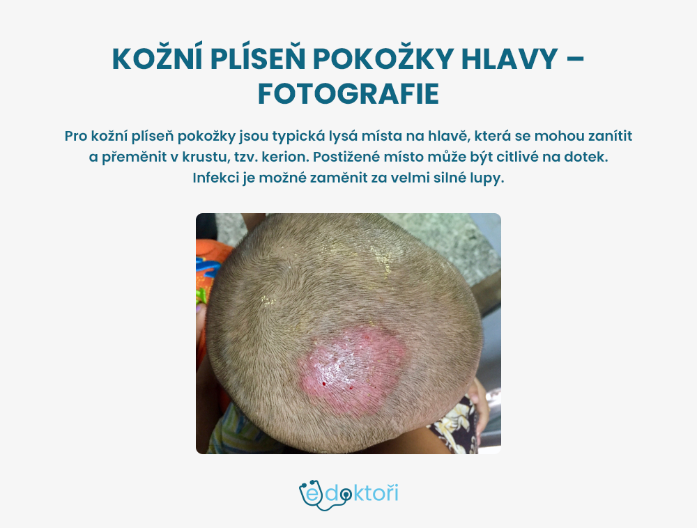plíseň kůže - tinea capitis foto