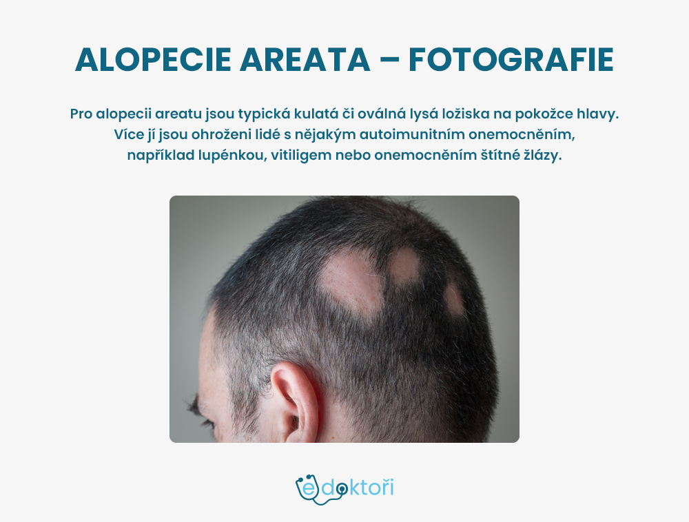 Alopecie areata