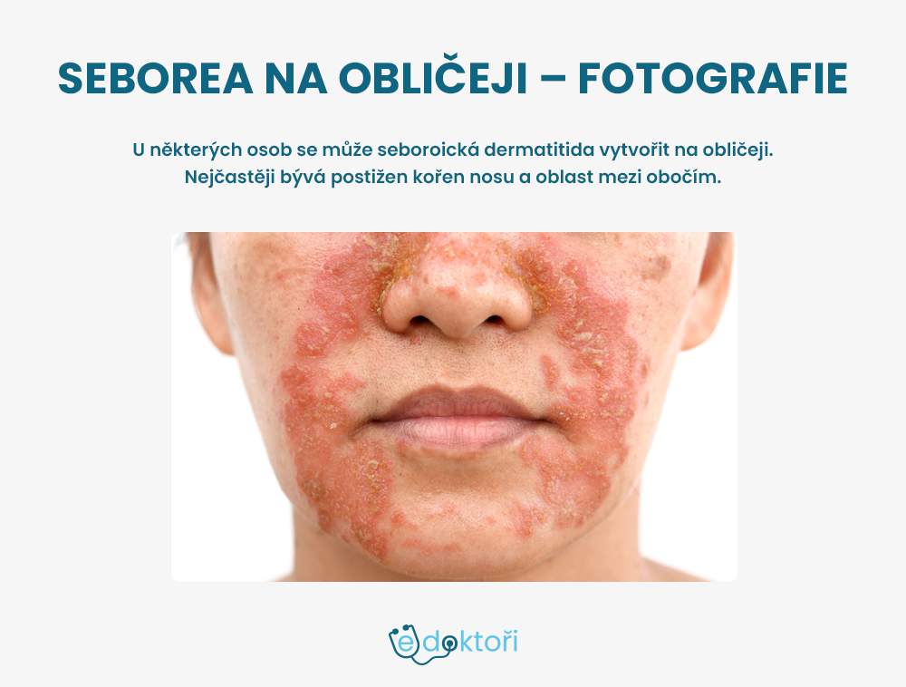Seborea v obličeji obrázky