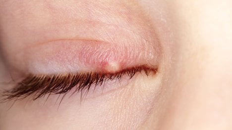 ječné zrno na víčku