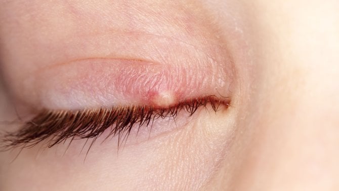 ječné zrno na víčku