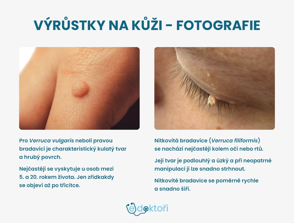 Bradavice fotografie