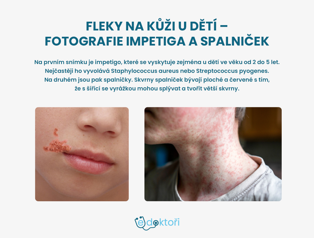 Fleky na kůži u dětí
