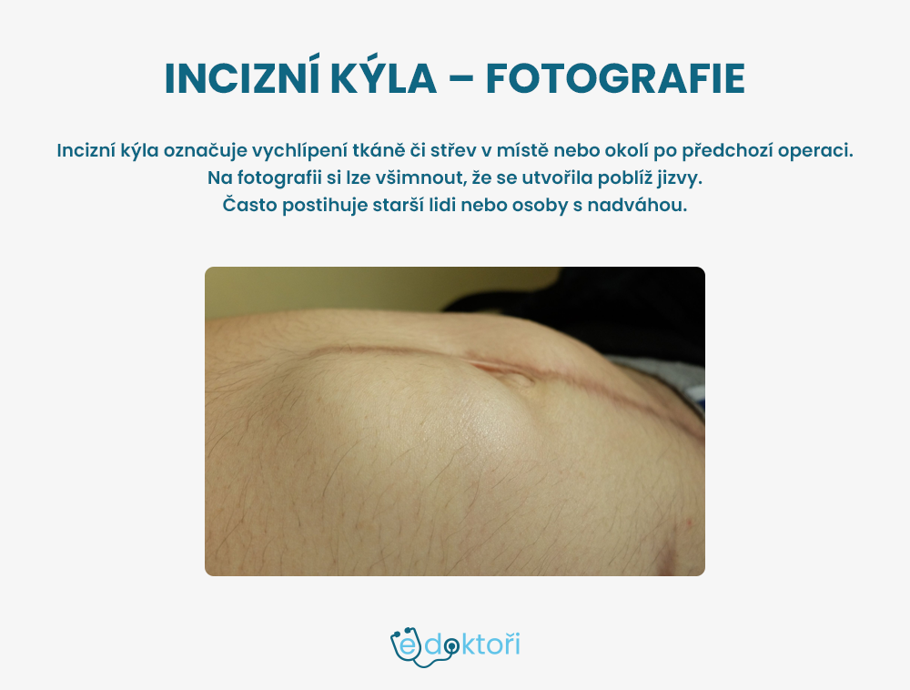 Incizní kýla - fotografie