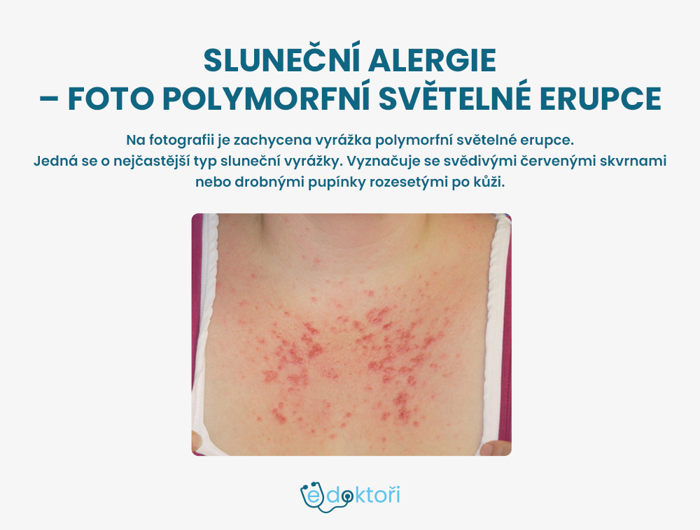 sluneční alergie fotky