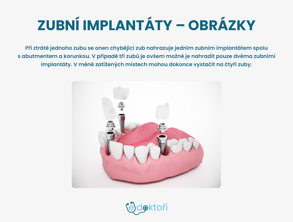 zubní implantát obrázky