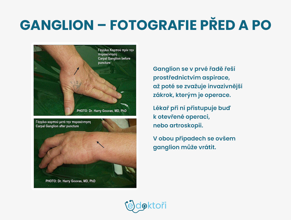 ganglion: fotografie
