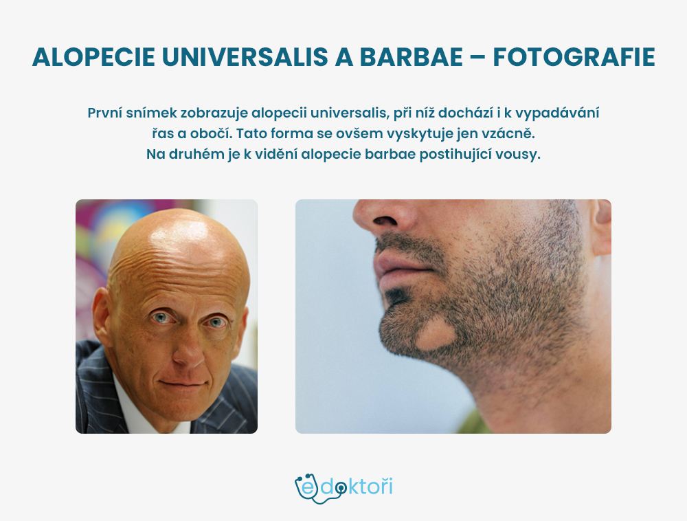 Alopecie barbae a universalis