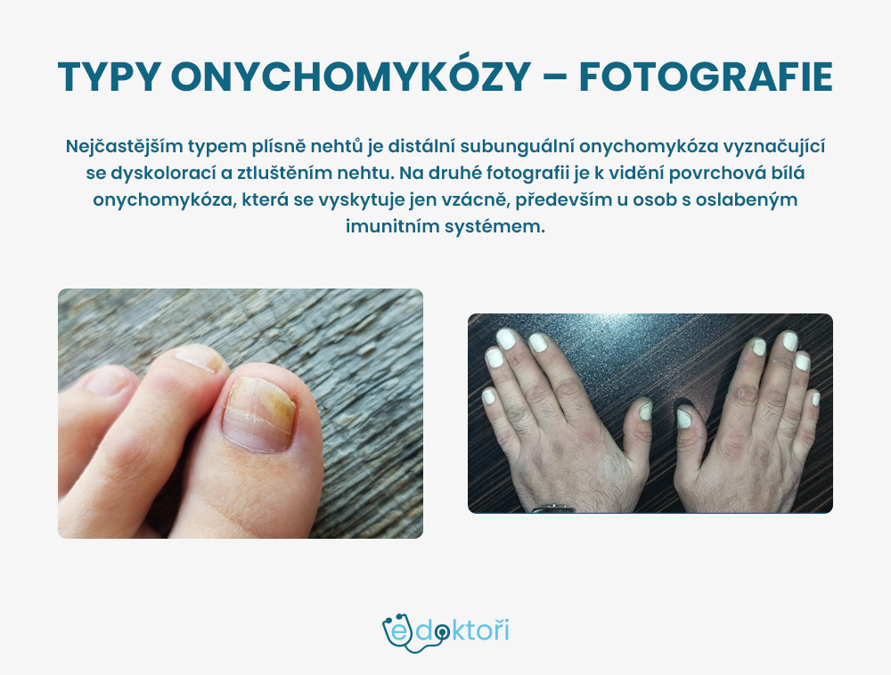 onychomykóza