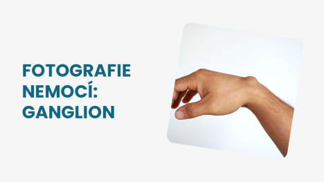 Ganglion na ruce