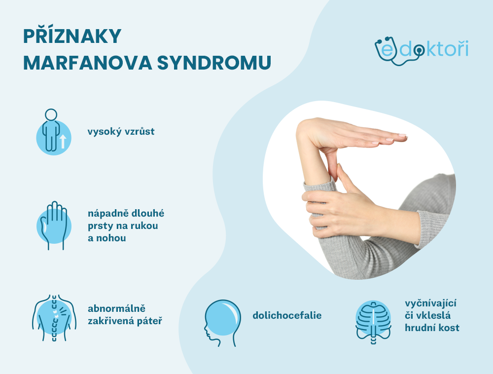 Autor: Redakce edoktori.cz příznaky Marfanova syndromu