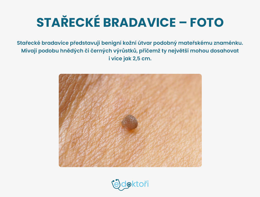 stařecké bradavice foto