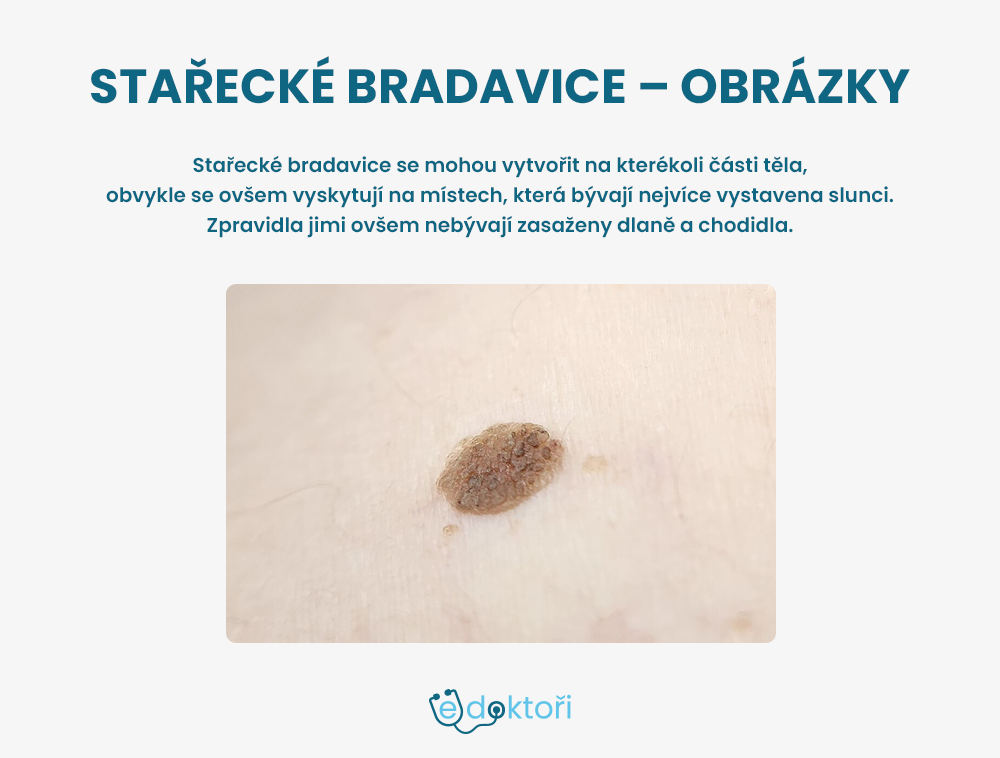 Stařecké bradavice obrázky