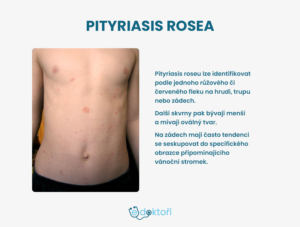 Pityriasis rosea fotografie
