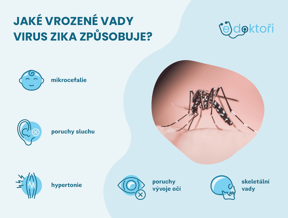 virus Zika a vrozené vady