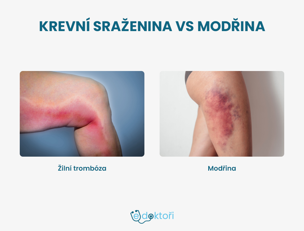 Krevní sraženina vs modřina