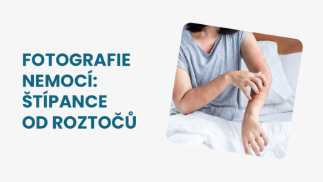 štípance od roztočů foto
