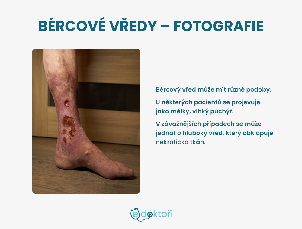 Bércové vředy foto