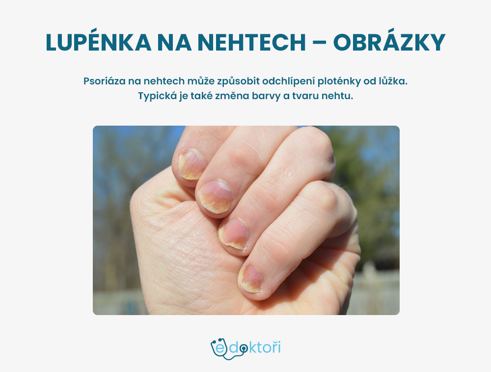 Lupénka na nehtech