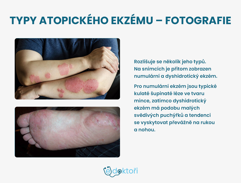 Atopický ekzém - fotografie numulárního a dyshidrotického ekzému