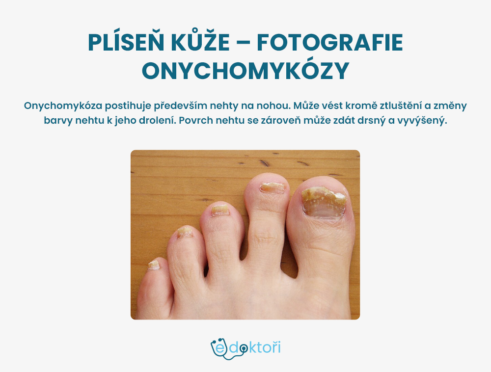 onychomykóza foto