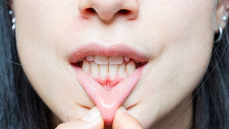 Obnažené zubní krčky