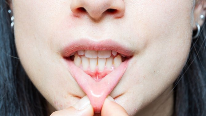 Obnažené zubní krčky