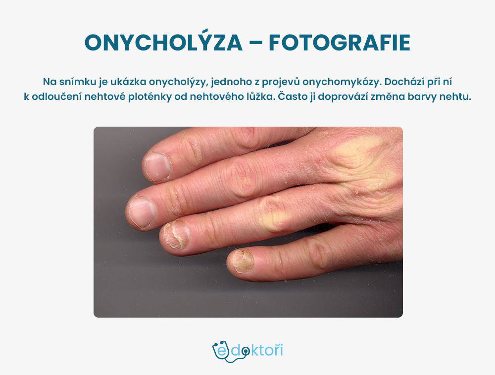 onycholýza