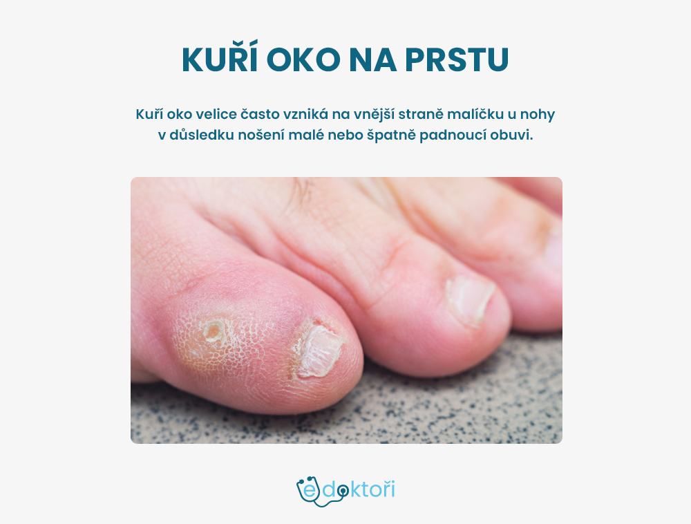 Kuří oko na prstu