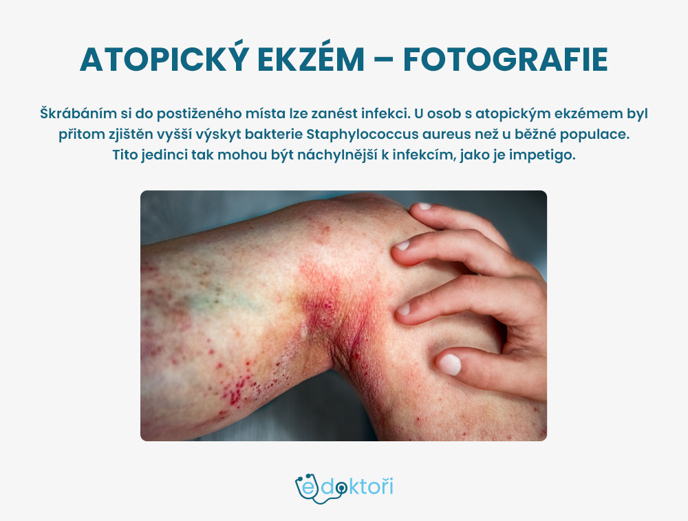 atopický ekzém - fotografie infekce