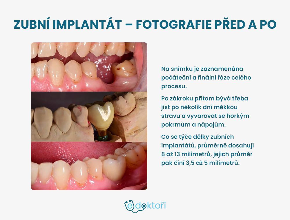 Zubní implantát fotografie před a po