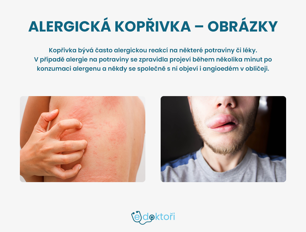 Alergická kopřivka obrázky
