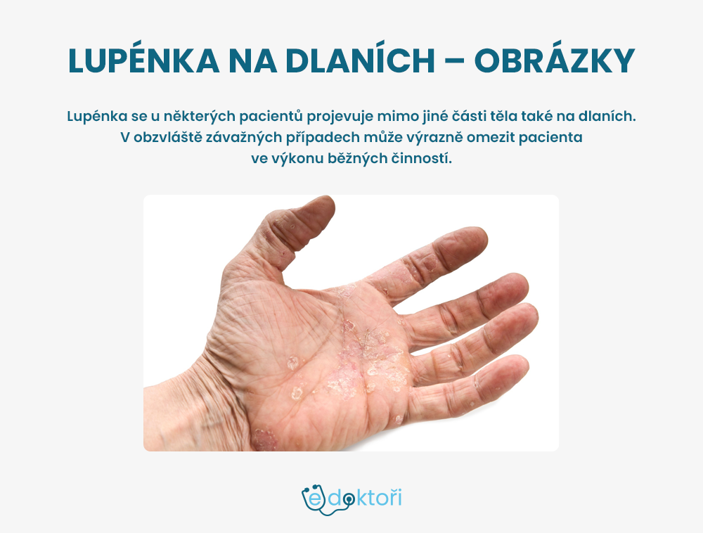 Lupénka na ruce