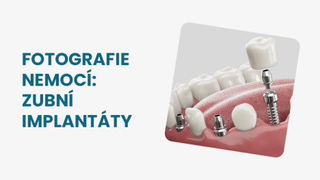Zubní implantát fotografie