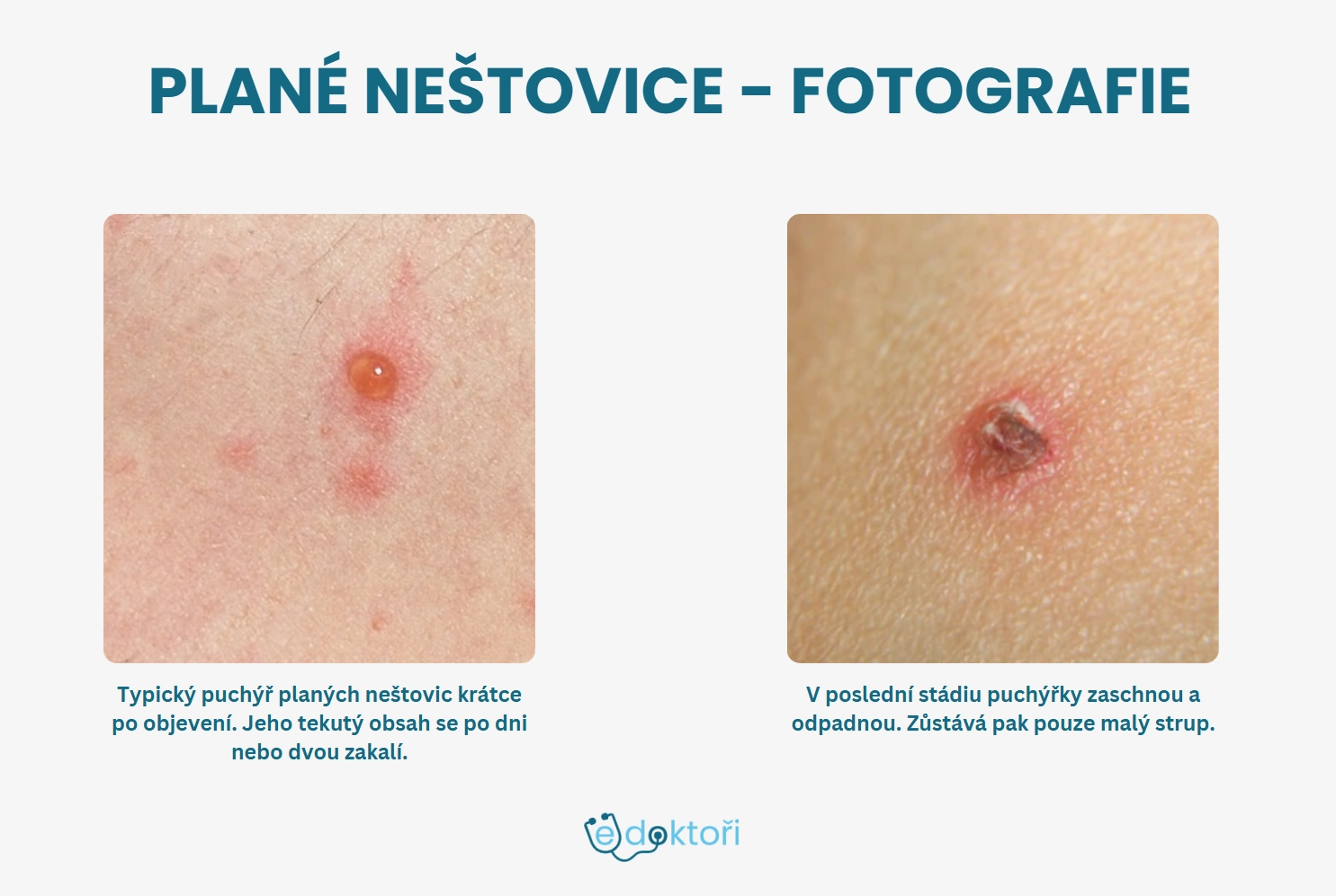 Neštovice příznaky foto