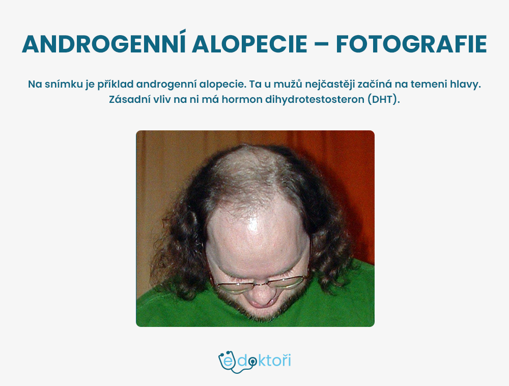 Androgenní alopecie