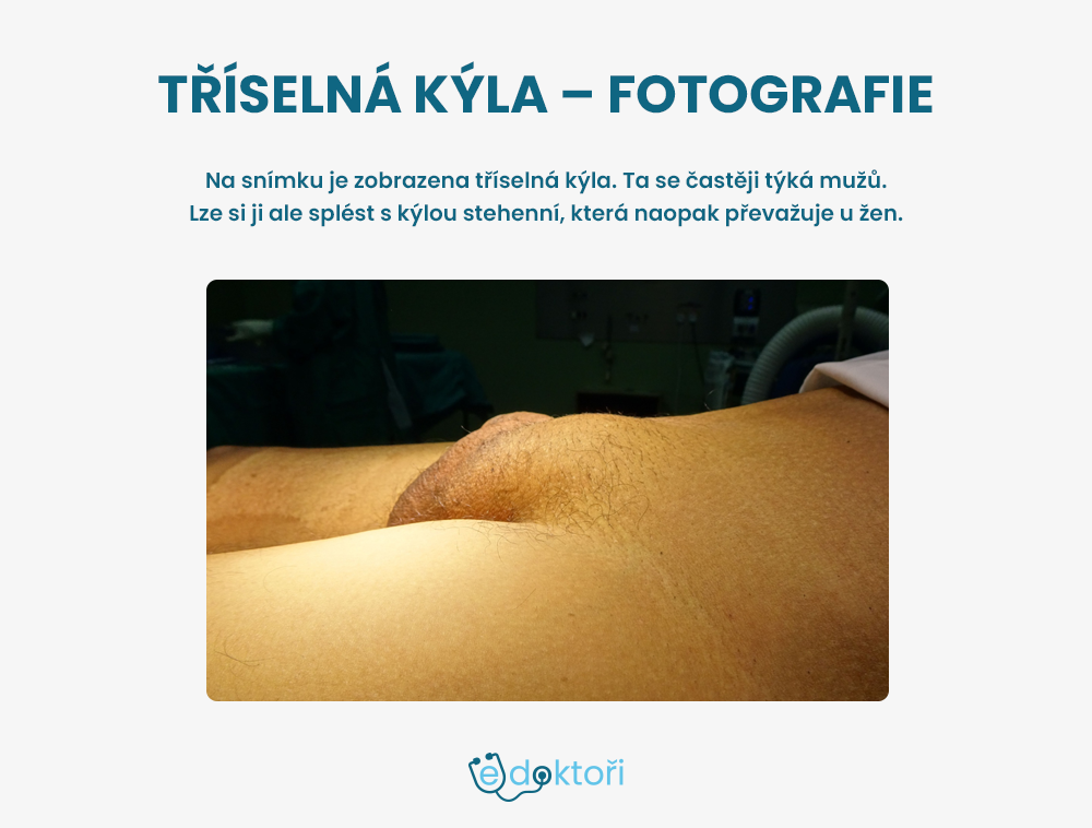 Tříselná kýla