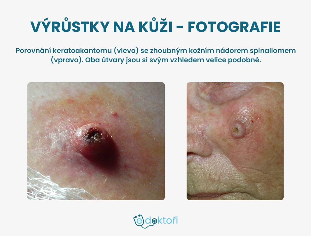 Porovnání keratoakantomu a spinaliomu