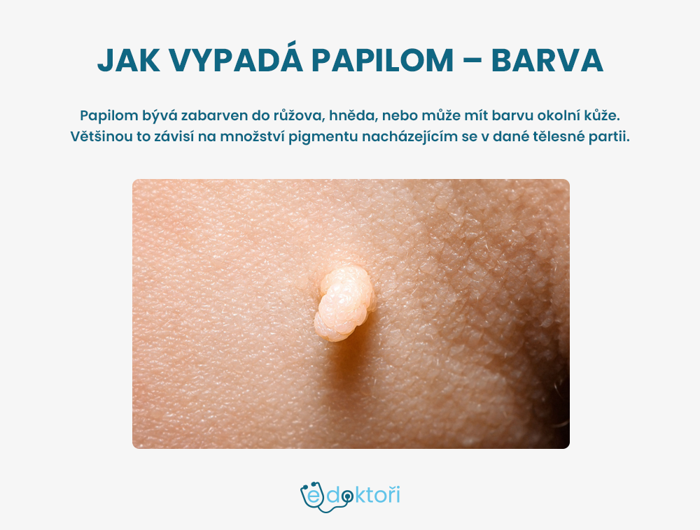 Jak vypadá papilom - barva