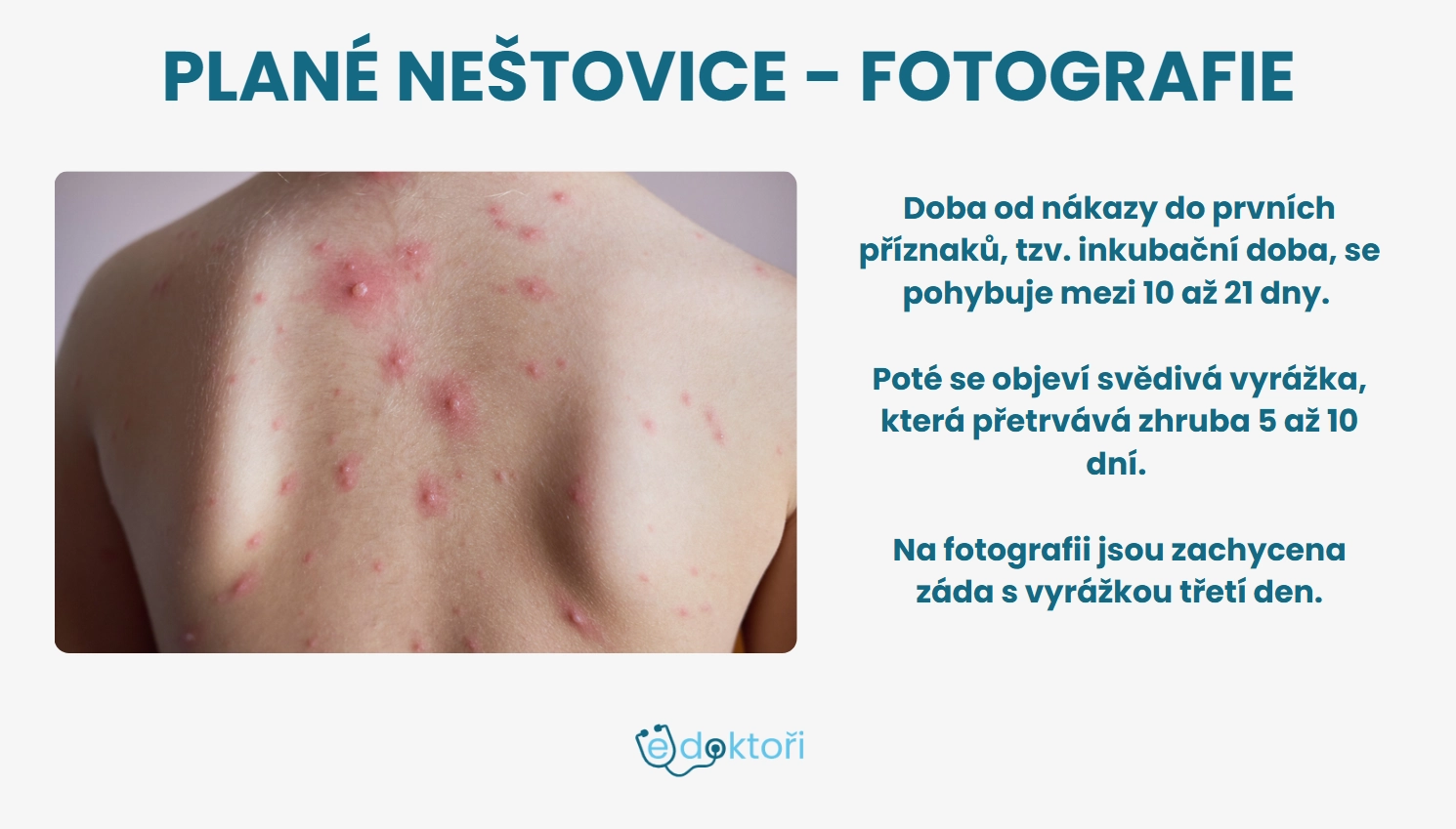 Neštovice obrázky