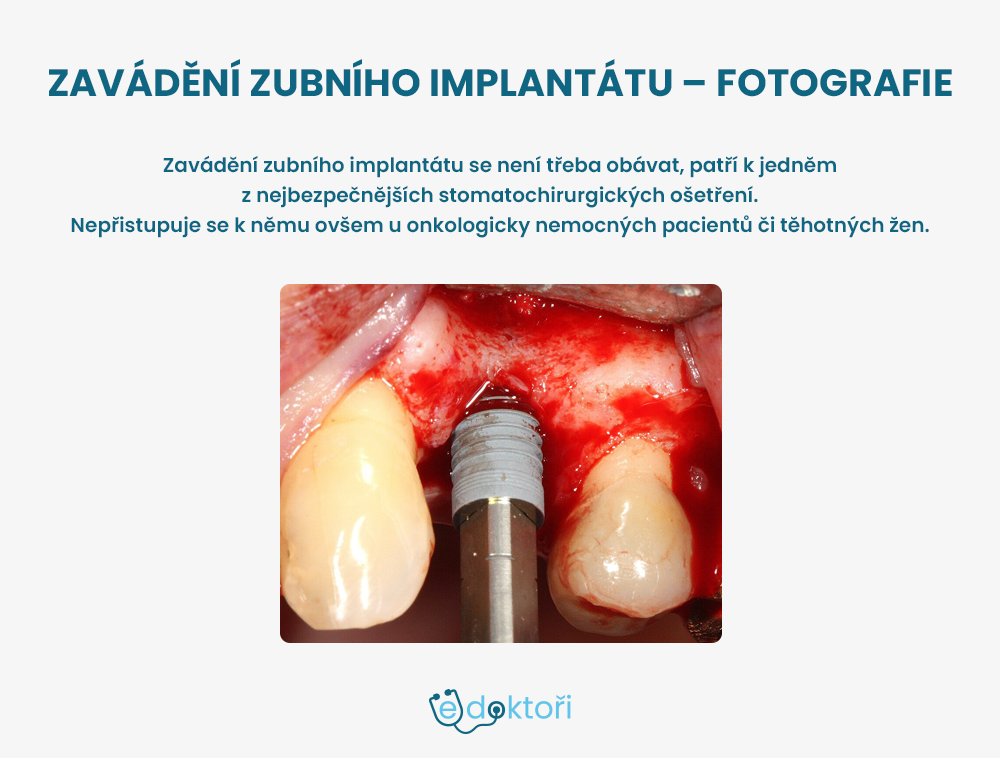 zubní implantát fotografie jeho zavádění