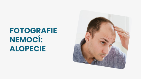 Alopecie