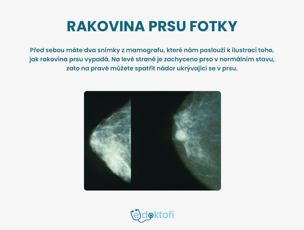 Autor: Redakce edoktori.cz rakovina prsu fotky
