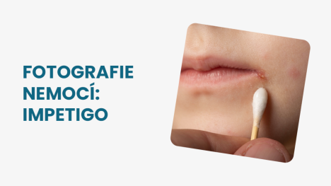 Impetigo obrázky