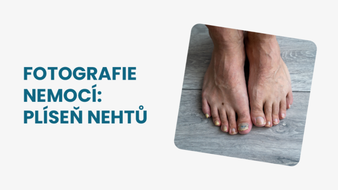 Plíseň nehtů
