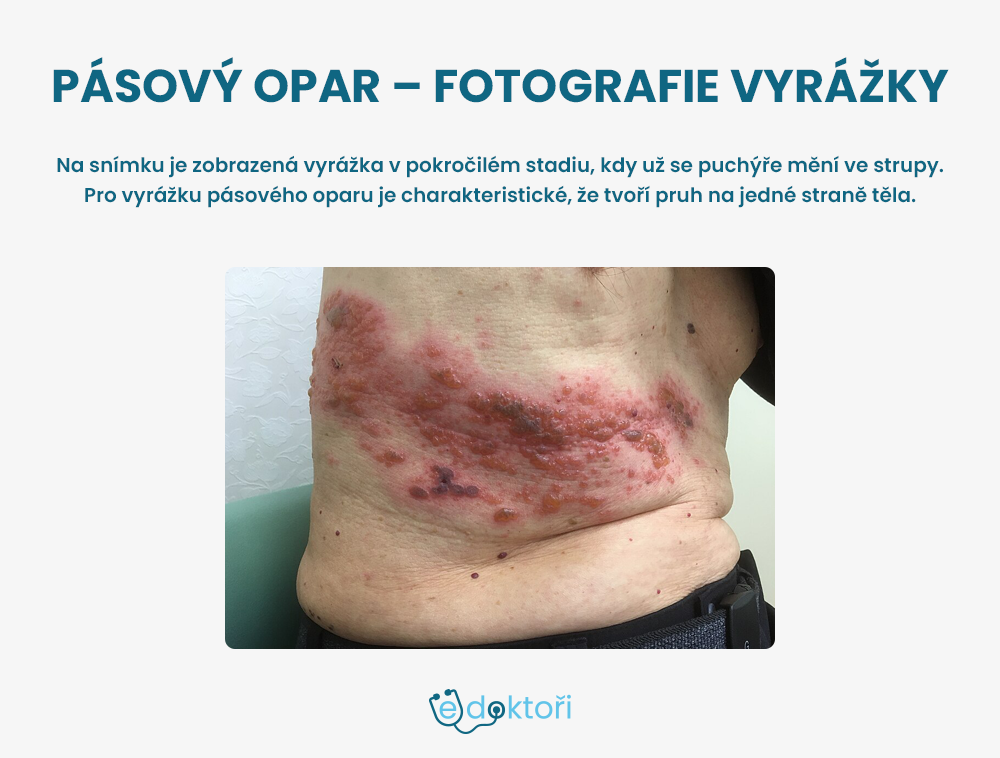Pásový opar na břiše - fotografie