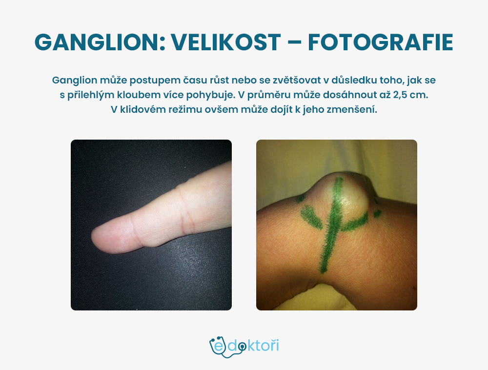 ganglion - fotografie